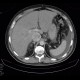 Renal carcinoma, tumorous thrombosis of inferior vena cava, pericardial metastasis: CT - Computed tomography