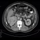 Renal carcinoma, tumorous thrombosis of inferior vena cava, pericardial metastasis: CT - Computed tomography