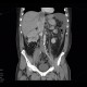 Renal carcinoma, tumorous thrombosis of inferior vena cava, pericardial metastasis: CT - Computed tomography