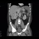 Renal carcinoma, tumorous thrombosis of inferior vena cava, pericardial metastasis: CT - Computed tomography