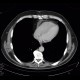 Renal carcinoma, tumorous thrombosis of inferior vena cava, pericardial metastasis: CT - Computed tomography
