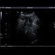 Colon metastases in the liver, CEUS: US - Ultrasound