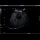 Colon metastases in the liver, CEUS: US - Ultrasound