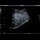 Colon metastases in the liver, CEUS: US - Ultrasound