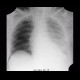 Muscular emphysema, pleural effusion, deep sulcus sign, pneumothorax, PNO: X-ray - Plain radiograph