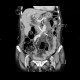 Migration of biliary drain, perforation of duodenum: CT - Computed tomography