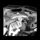Migration of biliary drain, perforation of duodenum: CT - Computed tomography