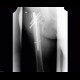 Migration of hardware, second radiograph, intramedullary hip screw: X-ray - Plain radiograph