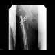 Migration of hardware, first radiograph, intramedullary hip screw: X-ray - Plain radiograph