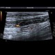 Mild colitis: US - Ultrasound