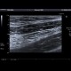 Mild colitis: US - Ultrasound