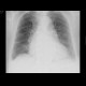 Mild lung congestion: X-ray - Plain radiograph