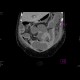 Multiple collections in the peritoneal cavity following stercoral peritonitis: CT - Computed tomography