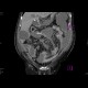 Multiple collections in the peritoneal cavity following stercoral peritonitis: CT - Computed tomography