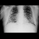 Metastatic disease of the lung: X-ray - Plain radiograph