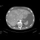Metastatic disease of the liver: CT - Computed tomography