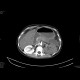 Multiple visceral thromboses of unknown etiology: CT - Computed tomography