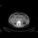 Multiple visceral thromboses of unknown etiology: CT - Computed tomography