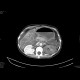 Multiple visceral thromboses of unknown etiology: CT - Computed tomography