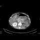 Multiple visceral thromboses of unknown etiology: CT - Computed tomography