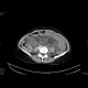 Multiple visceral thromboses of unknown etiology: CT - Computed tomography