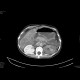 Multiple visceral thromboses of unknown etiology: CT - Computed tomography