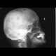 Multiple myeloma, lytic lesions: X-ray - Plain radiograph