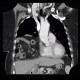 Morgagni hernia, diaphragmatic hernia, large, congenital: CT - Computed tomography