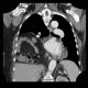 Morgagni hernia, diaphragmatic hernia, large, congenital: CT - Computed tomography