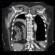 Morgagni hernia, diaphragmatic hernia, large, congenital: CT - Computed tomography