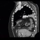 Morgagni hernia, diaphragmatic hernia, large, congenital: CT - Computed tomography