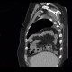 Morgagni hernia, diaphragmatic hernia, large, congenital: CT - Computed tomography