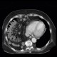 Morgagni hernia, diaphragmatic hernia, large, congenital: CT - Computed tomography