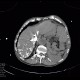 Aneurysm of abdominal aorta, AAA, ruptured, cardiac arrest, deceased: CT - Computed tomography