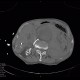 Aneurysm of abdominal aorta, AAA, ruptured, cardiac arrest, deceased: CT - Computed tomography