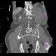 Aneurysm of abdominal aorta, AAA, ruptured, cardiac arrest, deceased: CT - Computed tomography