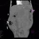 Aneurysm of abdominal aorta, AAA, ruptured, cardiac arrest, deceased: CT - Computed tomography