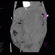 Aneurysm of abdominal aorta, AAA, ruptured, cardiac arrest, deceased: CT - Computed tomography