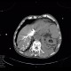 Aneurysm of abdominal aorta, AAA, ruptured, cardiac arrest, deceased: CT - Computed tomography