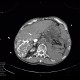 Aneurysm of abdominal aorta, AAA, ruptured, cardiac arrest, deceased: CT - Computed tomography