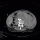 Aneurysm of abdominal aorta, AAA, ruptured, cardiac arrest, deceased: CT - Computed tomography