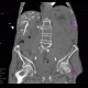 Aneurysm of abdominal aorta, AAA, ruptured, cardiac arrest, deceased: CT - Computed tomography