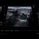 Mucocoele of submandibular gland: US - Ultrasound