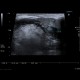 Mucocoele of submandibular gland: US - Ultrasound