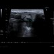 Mucocoele of submandibular gland: US - Ultrasound