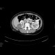 Renal cell carcinoma, multilocular and cystic: CT - Computed tomography