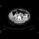 Renal cell carcinoma, multilocular and cystic: CT - Computed tomography