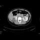 Renal cell carcinoma, multilocular and cystic: CT - Computed tomography