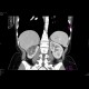 Renal cell carcinoma, multilocular and cystic: CT - Computed tomography