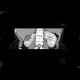 Renal cell carcinoma, multilocular and cystic: CT - Computed tomography